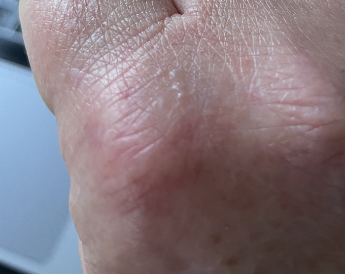 Mosquitoes - "What's going on with Mosquitoes in the UK?", Mosquitoes -“What’s going on with the mosquitoes in the UK?”, Full Body Massage Service