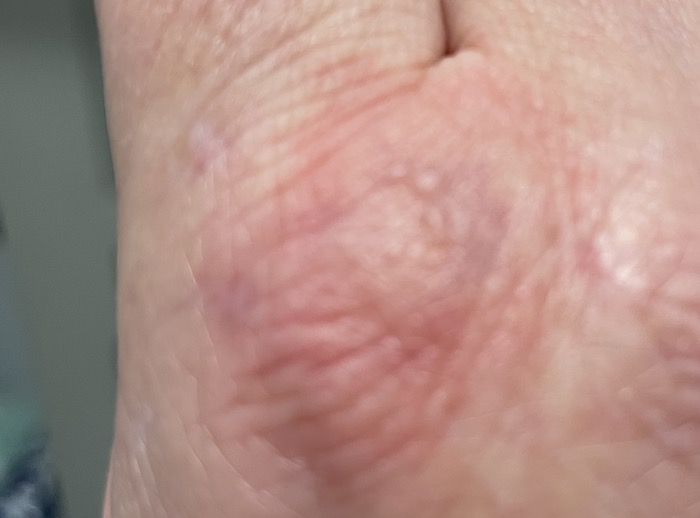 Mosquitoes - "What's going on with Mosquitoes in the UK?", Mosquitoes -“What’s going on with the mosquitoes in the UK?”, Full Body Massage Service