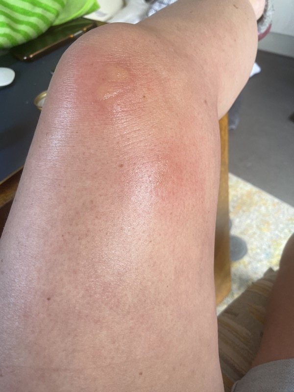 Mosquitoes - "What's going on with Mosquitoes in the UK?", Mosquitoes -“What’s going on with the mosquitoes in the UK?”, Full Body Massage Service