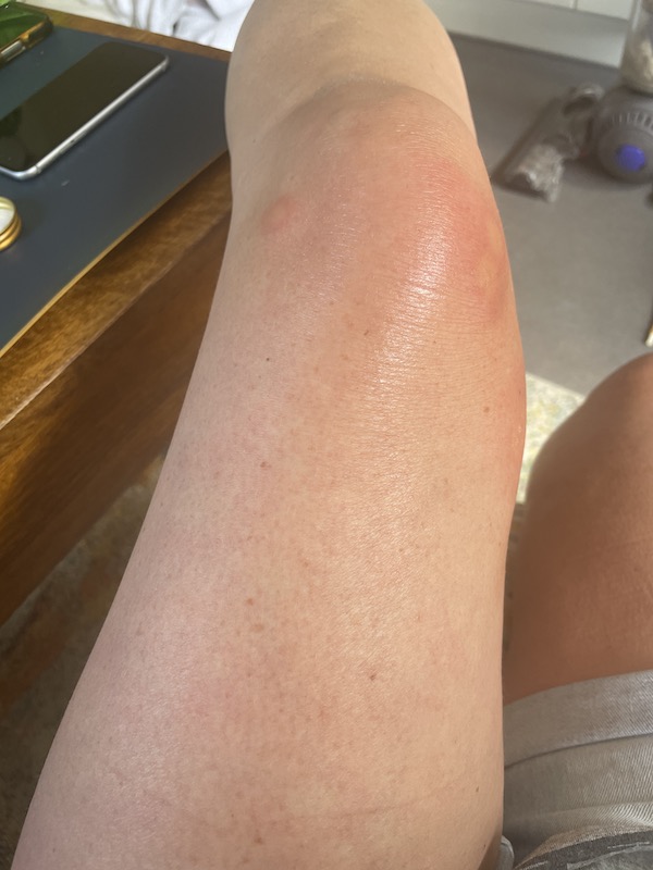 Mosquitoes - "What's going on with Mosquitoes in the UK?", Mosquitoes -“What’s going on with the mosquitoes in the UK?”, Full Body Massage Service