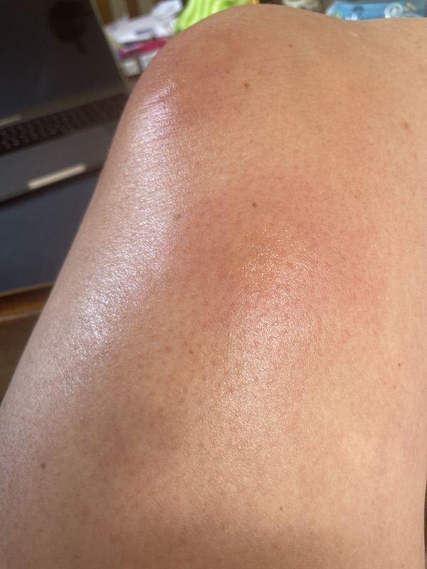Mosquitoes - "What's going on with Mosquitoes in the UK?", Mosquitoes -“What’s going on with the mosquitoes in the UK?”, Full Body Massage Service