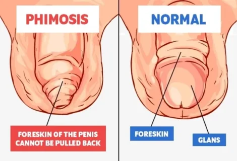 The Foreskin